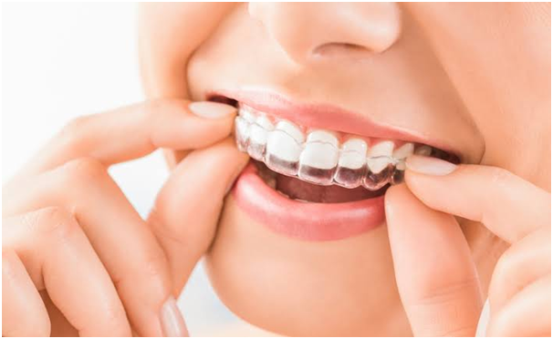 Windsor Invisalign, Dental Implants Maidenhead & Invisalign in Maidenhead: The Modern Smile Solution by The Dental Surgery Burnham